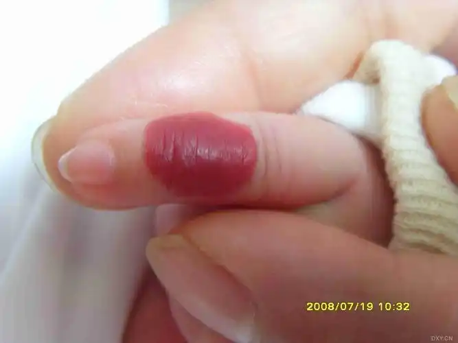 【求助】刚满月的小孩手指上长了个血管瘤