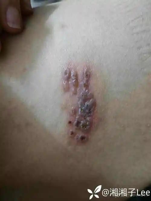 被虫咬了一口,入院后1天多器官衰竭,这是啥虫?