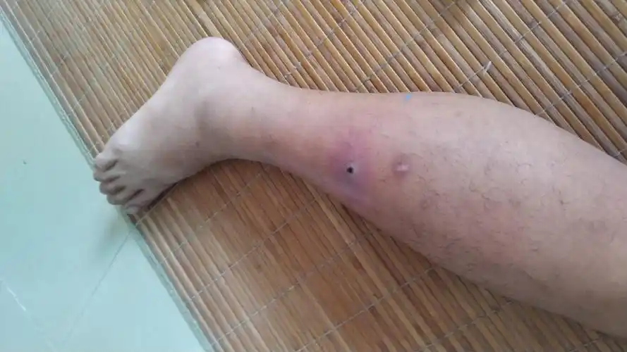 小腿肿很大硬硬的,刚开始很小,后来去挤压,就越变越大,站在会痛