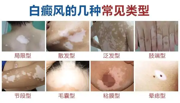 白癜风早期症状图片