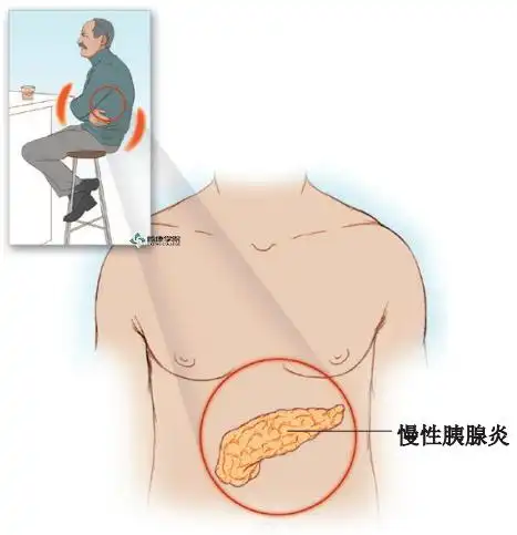 疼痛解剖学慢性胰腺炎