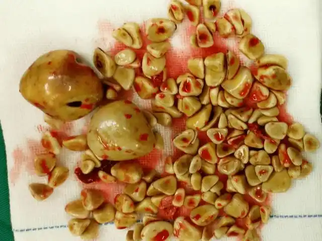 来自146颗结石的启示:"不疼的"胆结石更要命