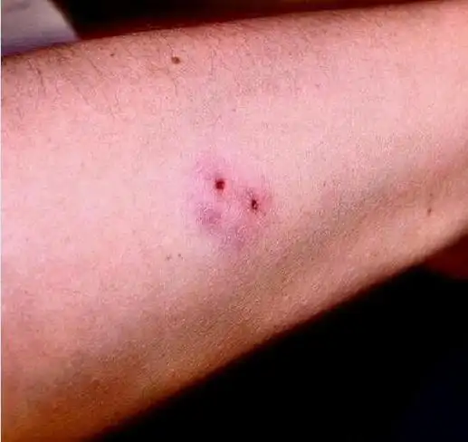 被小蛇咬了的伤口图片大全