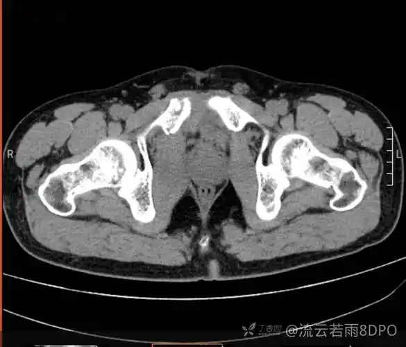 右侧耻骨上下支骨折