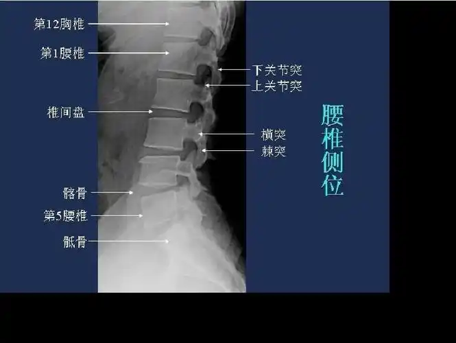 脊柱影像解剖和峡部裂的影像学表现