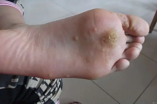 这样的跖疣如何治疗好?