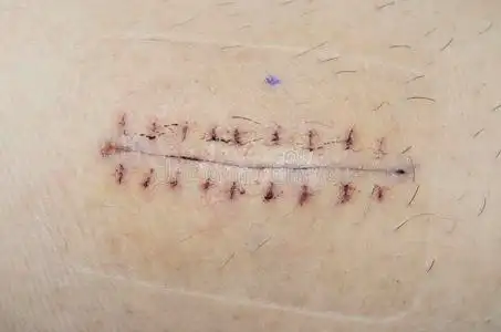 手术疤痕照片