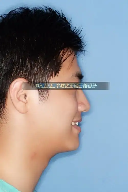 正颌正畸咨询前指南