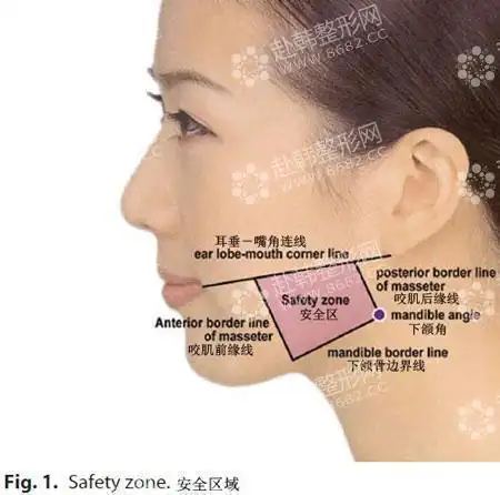 注意:瘦脸针注射正确部位
