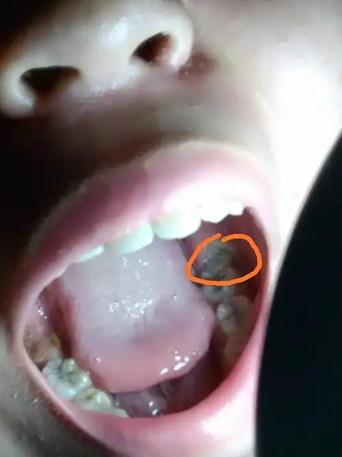 展开全部 你好,根据您描述的长智齿的情况,如果是不疼不痒对于其他