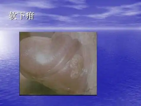 由于其发病率很高,仅次于梅毒和淋病,位居第三,软下疳早期有什么症状