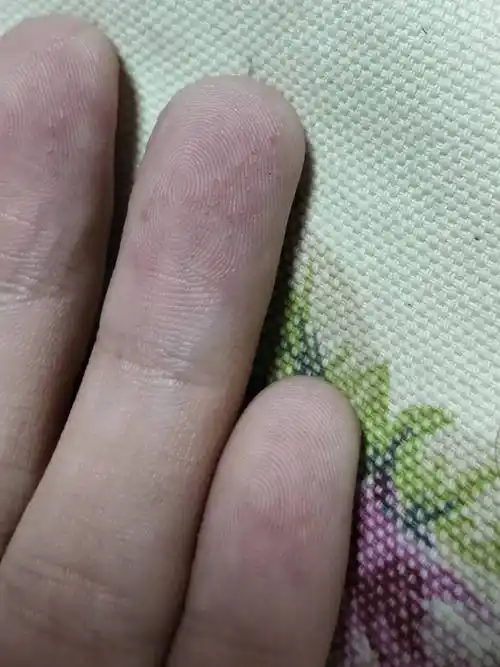 【医生回答】手指上面出现这些水泡,考虑是由于汗疱疹引起的,是一种