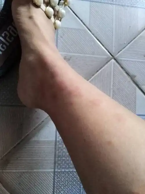 家里有小黑虫被咬了,红肿痒,请问怎么去这种小黑虫