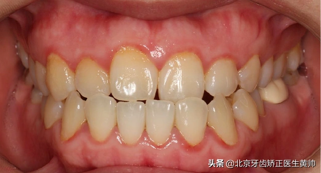 地包天怎么判断是骨性(怎么判断自己是不是地包天)-第1张图片