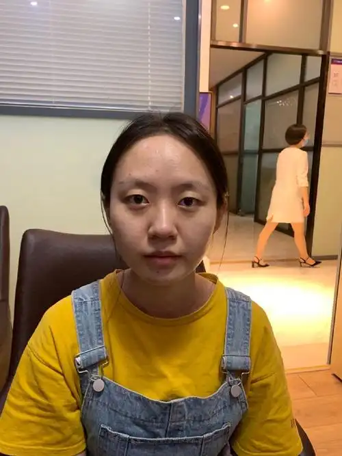 术前上睑松弛 眼球突出 上睑凹陷 不适合做很宽的双眼皮