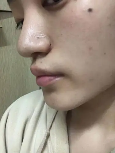 【术后30天】做完缩鼻翼已经一个月了,现在疤痕部位_圈子-新氧美容