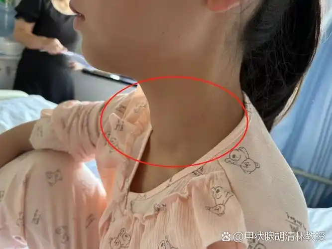 【孩子吃得多饿得快,体重还下降?小心!】 说到甲亢不少人觉得,"这是成