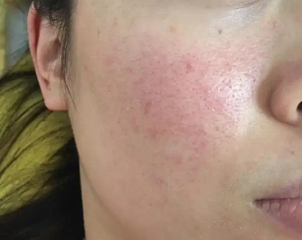 玫瑰痤疮?怎么办,谁来拯救我的脸,中医西医看过无数