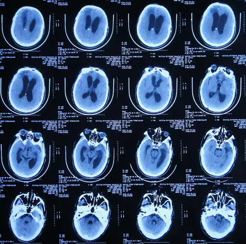 图-24:2020年1月22日头颅核磁图-25:2020年1月29日头颅ct图-26:2020年