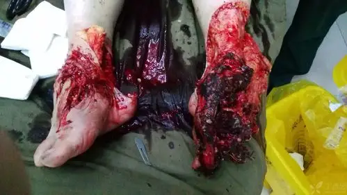 双足毁损皮肤撕脱伤 [病例帖]