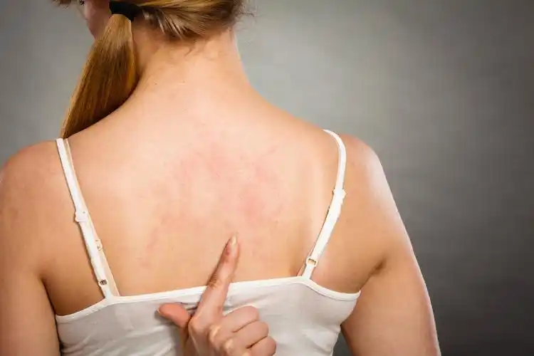 摄图网_300883788_健康问题,皮肤病轻女子表现出背部瘙痒过敏皮疹荨