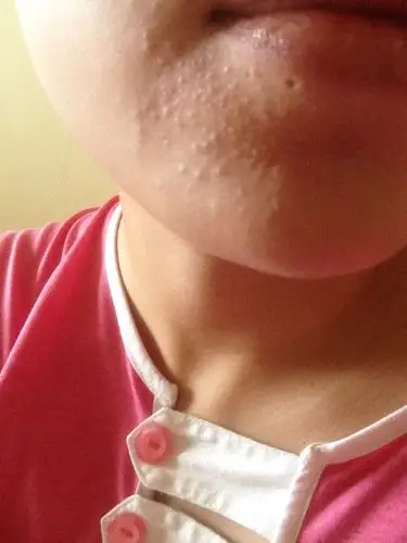 下巴起这些小碎疙瘩 米粒似的一片不疼不痒没感觉是怎么回事?