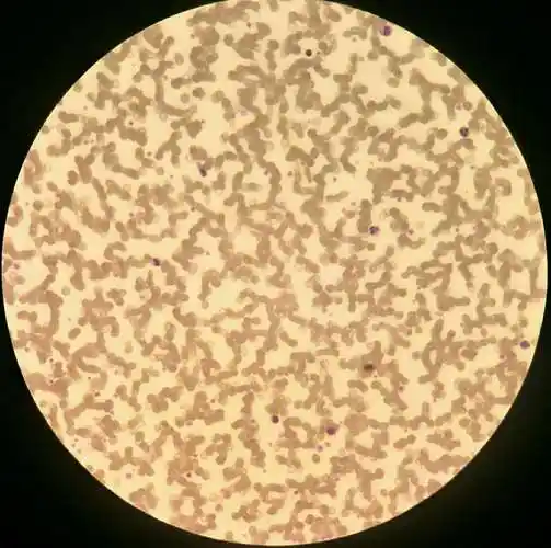 分享一例大血小板增多引起的血小板假性减低病例