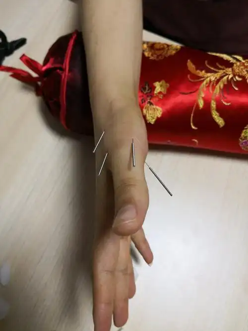 黄帝内针案例分享:拇指腱鞘炎两例 - 简书