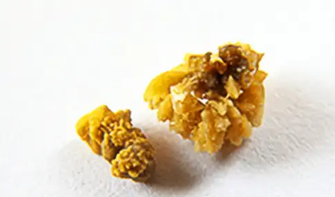 肾结石,真的可以自己排出来吗?你或许真的不知道,看专家的理解