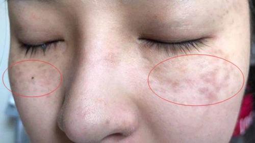 又叫颧骨母斑,是一种先天性非遗传性的皮肤色素性疾病.