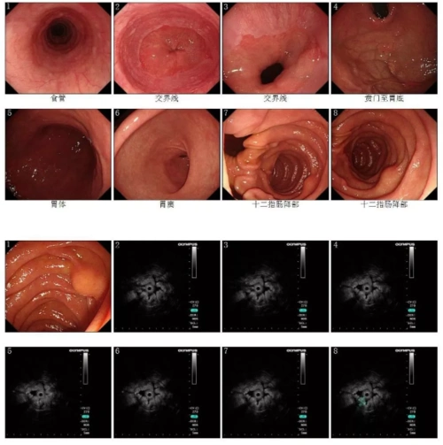 贲门病变早期食管病变内镜诊断及处理