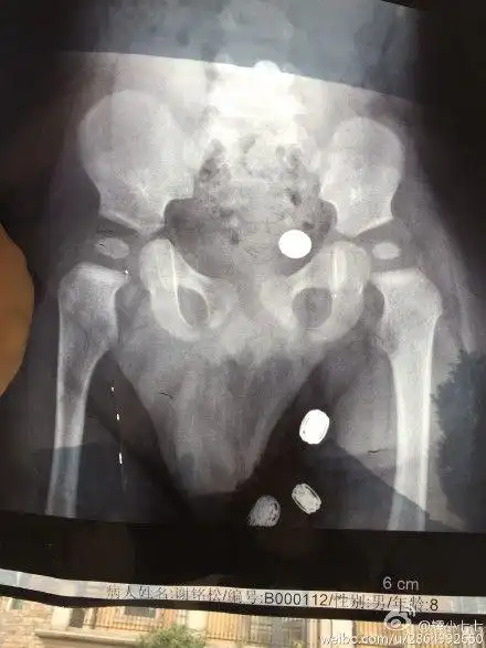 鲍医生,这是我家宝宝在8个月的时候(男孩)髋关节正位x光片,是否正常?