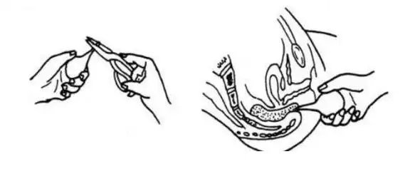 开塞露,您用对了吗?