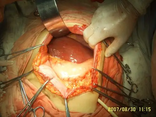 介绍个巨脾图片给大家看看