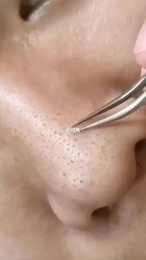 太费时了_去黑头_毛孔粗大_黑头粉刺_去黑头方法_美妆_护肤