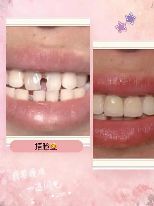 【二氧化锆全瓷牙】爱尔创二氧化锆全瓷牙修复牙齿缺失缺损变色牙修复