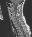 急性横贯性脊髓炎