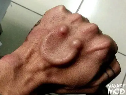 卡戴珊和朋友圈的女孩做了皮下植入这是个什么吓人玩意儿啊