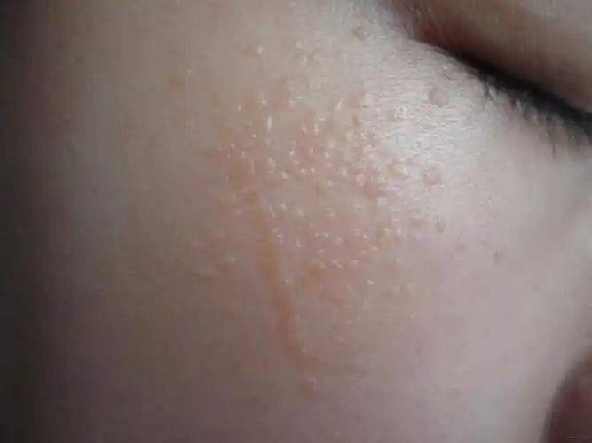 扁平疣图片_扁平疣症状表现图片大全_有来医生