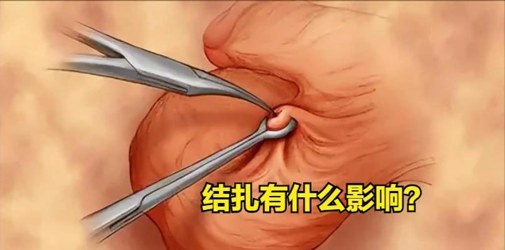 "男性做结扎手术对身体有什么影响吗?