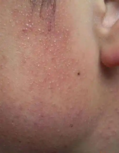 787878 毛周角化症如果你的胳膊,大腿,脸颊等部位的皮肤有毛囊