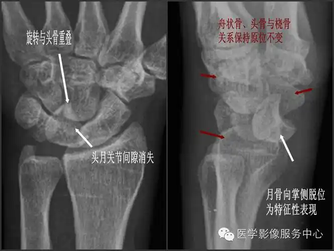 脱位为特征性表现;①正位片月上骨旋转与头骨重叠,头月关节,桡月关节