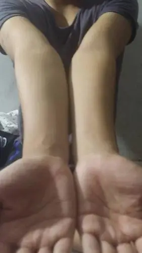 各位大哥大姐,我手臂肘外翻严重吗?大概多少度?当兵体检能过