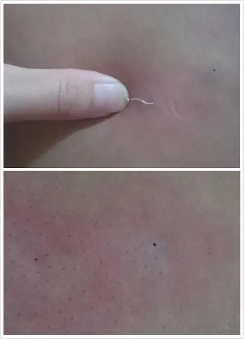 这是粉刺还是皮肤病?