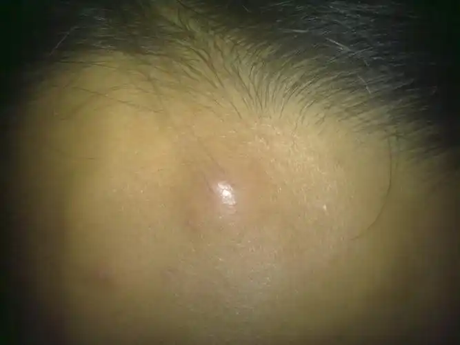 是怎么了?包可以随皮肤移动,一开始会疼,现在不疼了,有一厘米大!