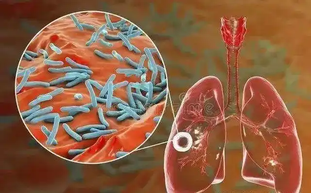 今天是世界防治结核病日.