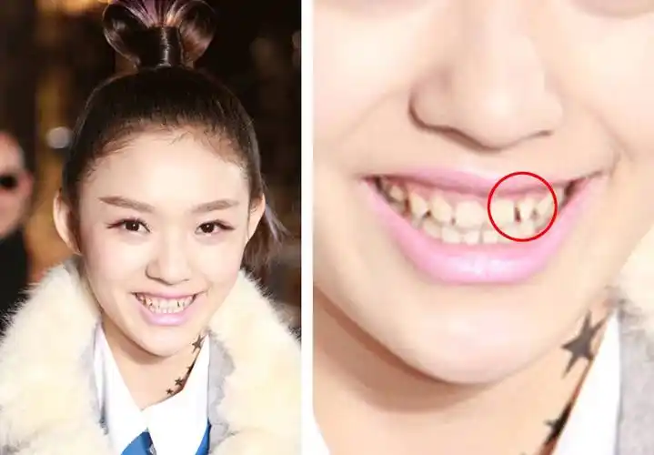 非行业人士的专业研究——如何用肉眼识别明星的假牙?