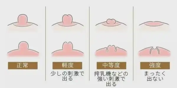 女性的乳头凹陷是怎么回事?每个女孩子的咪咪都不一样吗?