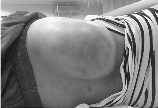 中暑后用陶瓷碗刮痧 她的腰上鼓起足球般大的包