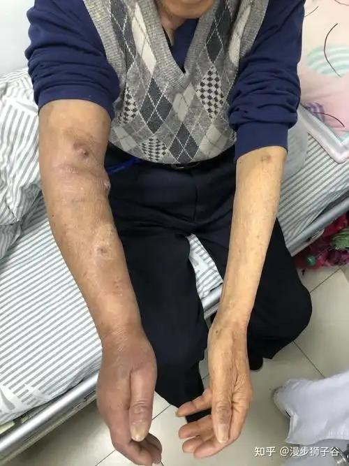 肿胀较前明显加重,每次血透后内瘘穿刺点需要3到4个小时绷带加压包扎